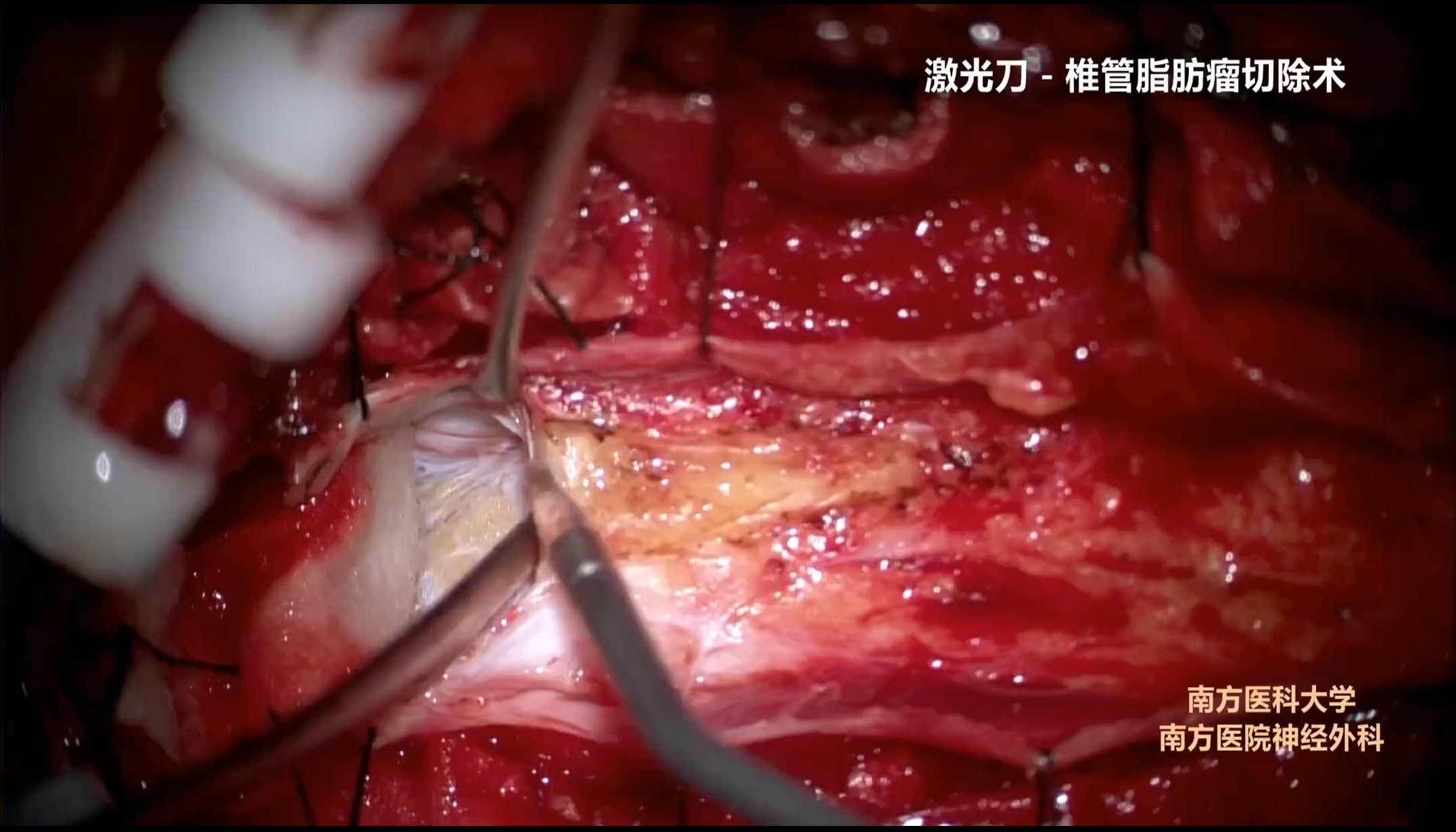 椎管脂肪瘤切除手术——南方医科大学南方医院神经外科